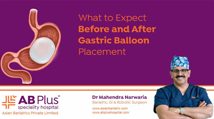 What to Expect Before and After Gastric Balloon Placement