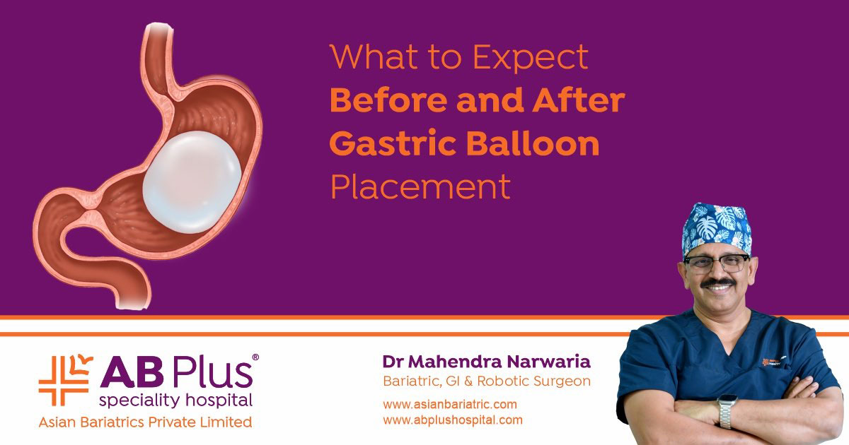 Before and After Gastric Balloon Placement