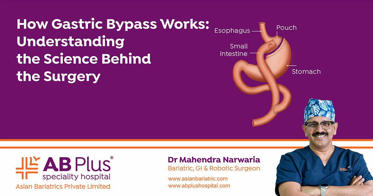 How Gastric Bypass Works: Understanding the Science Behind the Surgery